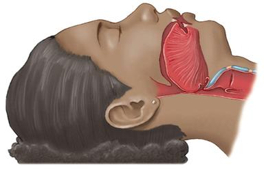 ODRŽAVANJE PROHODNOSTI DIŠNIH PUTOVA 
